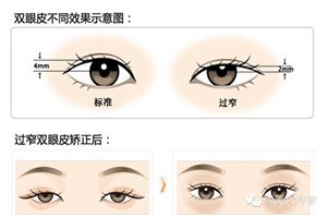 双眼皮失败后，常见的失败双眼皮六大修复方法！(图13)