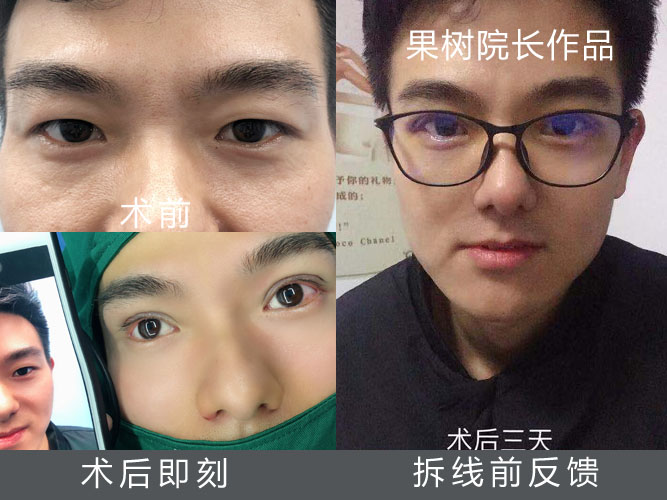 来自天津的帅哥做完男士双眼皮，术后三天就恢复的很完美，附真人案例(图1)