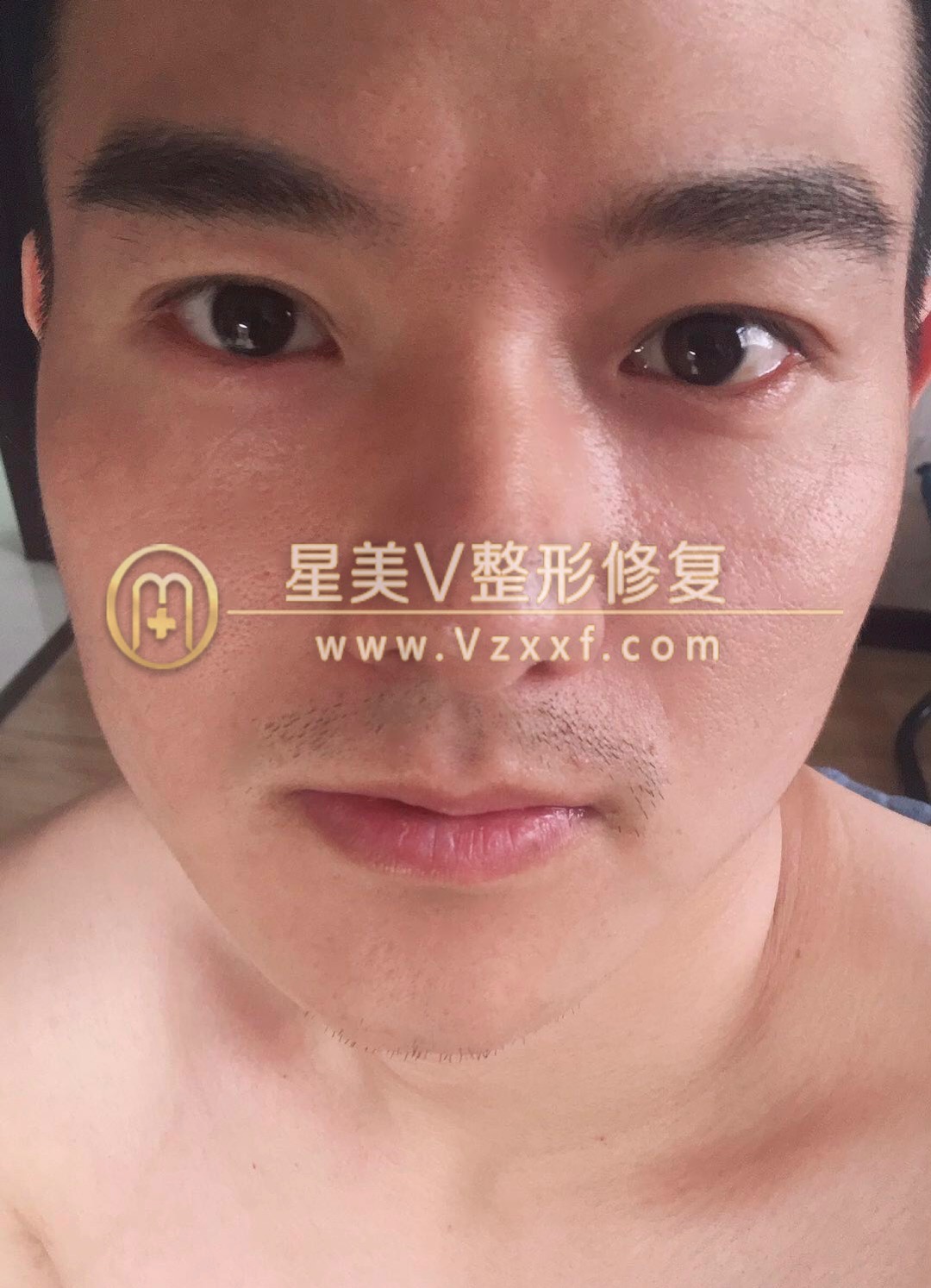 来自天津的帅哥做完男士双眼皮，术后三天就恢复的很完美，附真人案例(图8)