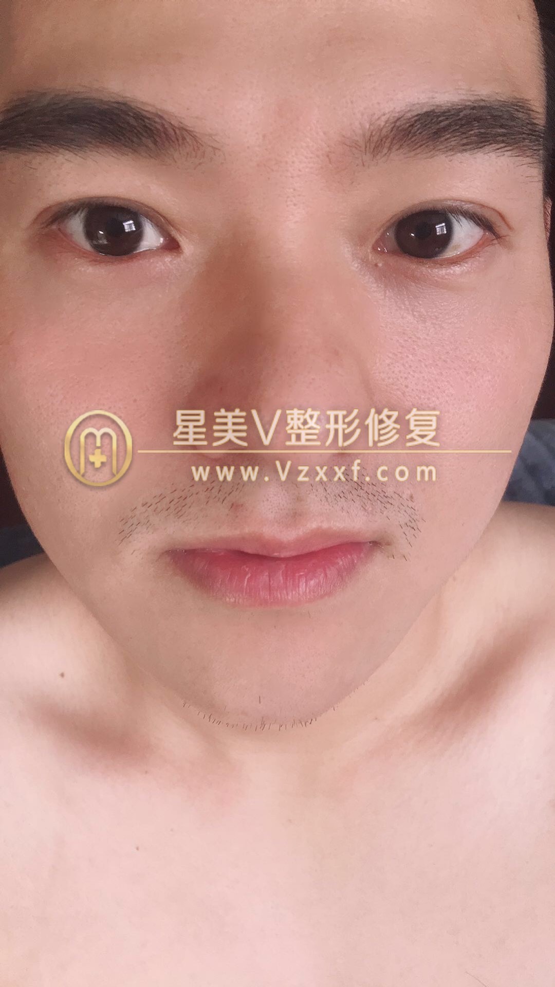 来自天津的帅哥做完男士双眼皮，术后三天就恢复的很完美，附真人案例(图7)