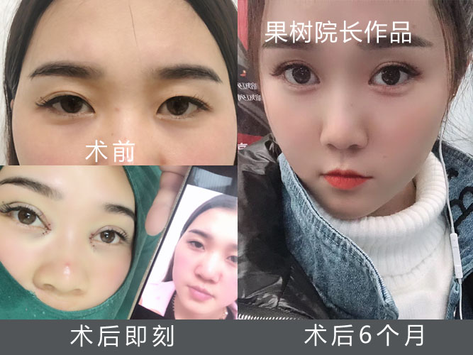 来自北京埋线双眼皮双侧不对称，大小眼，微创修复双眼皮完美修复(图1)