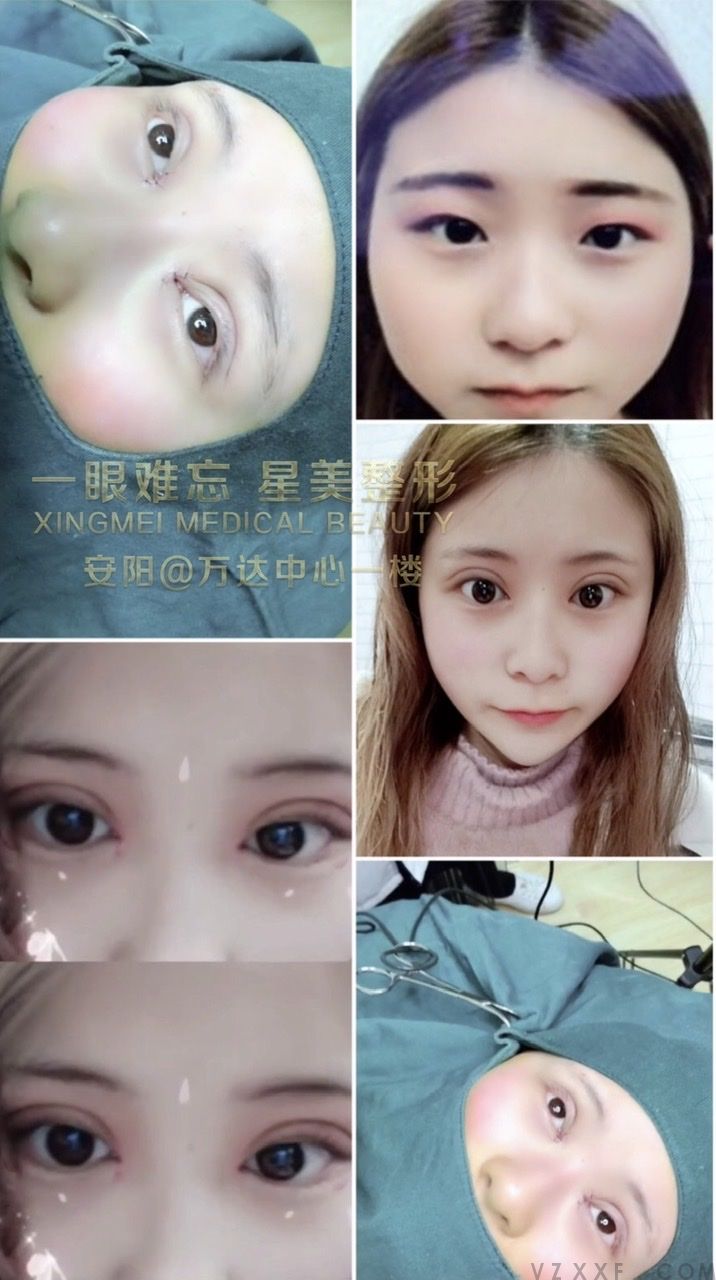 来自徐州的主播小姐姐做完双眼皮变化很大(图2)