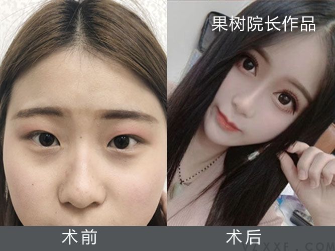 来自徐州的主播小姐姐做完双眼皮变化很大(图1)